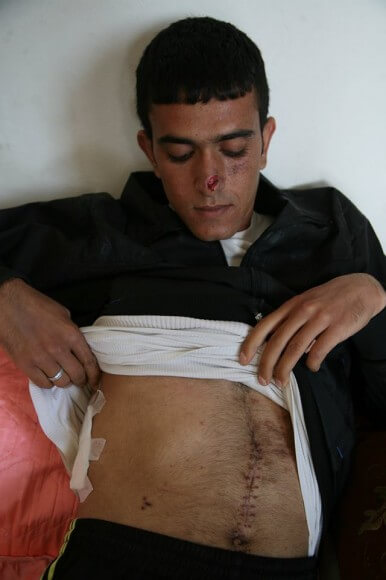 Yasin displaying his wounds, the bandaged bullet wound on his ribs, the scar from surgery done to extract dum dum bullet fragments, and a deep gash on his nose from a .22 caliber sniper bullet.  