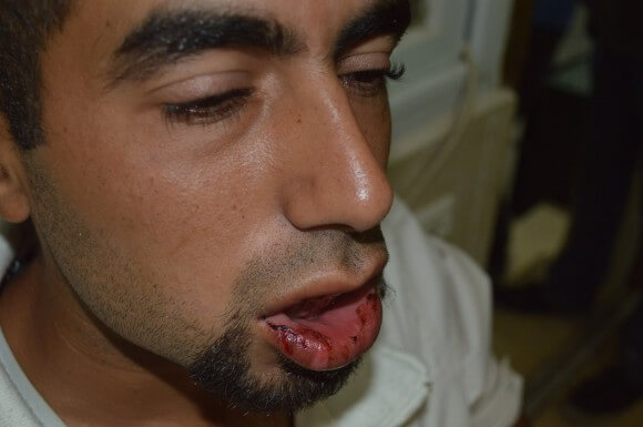 Khalil Nashash after being attacked by IDF dog. (Photo: Sheren Khalel)
