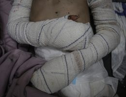 Hanan Akel, 9, who suffered burn injuries from an Israeli strike on Bureij refugee camp, at al-Aqsa Martyrs Hospital, June 21, 2024. (Photo: Omar Ashtawy/APA Images)