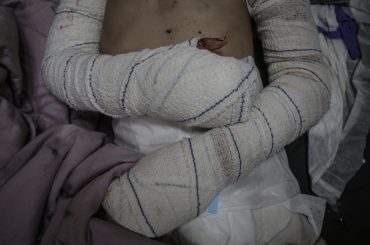 Hanan Akel, 9, who suffered burn injuries from an Israeli strike on Bureij refugee camp, at al-Aqsa Martyrs Hospital, June 21, 2024. (Photo: Omar Ashtawy/APA Images)