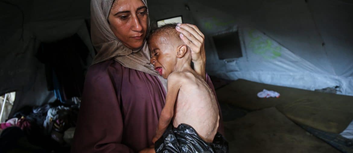 Muhammad Zakaria al-Mutawaq, an 18-month-old child facing life-threatening starvation, July 24, 2025. (Photo: Omar Ashtawy/APA Images)