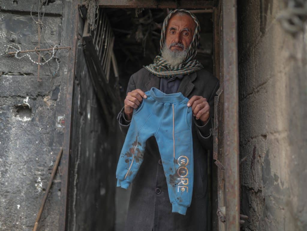 18-month-old Jawad Abu Nassar was returned by the Israeli army top his family with burn marks and puncture wounds, in what the family says was the result of torture, according to doctors, March 24, 2026. (Photo: Ramzi Abu Amer/APA Images)