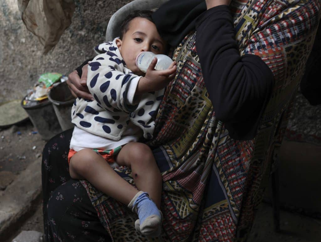 18-month-old Jawad Abu Nassar was returned by the Israeli army top his family with burn marks and puncture wounds, in what the family says was the result of torture, according to doctors, March 24, 2026. (Photo: Ramzi Abu Amer/APA Images)