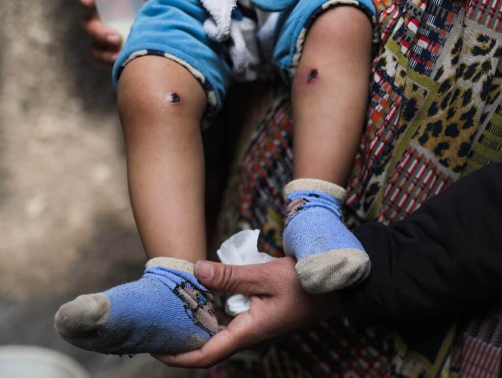 18-month-old Jawad Abu Nassar was returned by the Israeli army top his family with burn marks and puncture wounds, in what the family says was the result of torture, according to doctors, March 24, 2026. (Photo: Ramzi Abu Amer/APA Images)