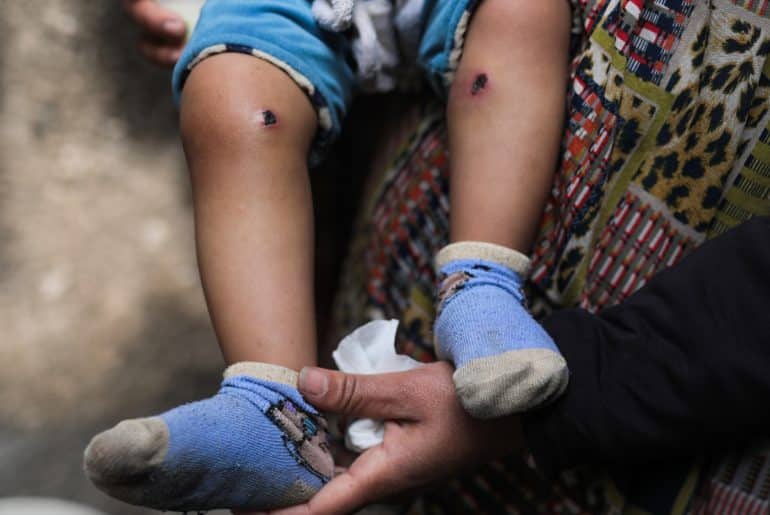 18-month-old Jawad Abu Nassar was returned by the Israeli army top his family with burn marks and puncture wounds, in what the family says was the result of torture, according to doctors, March 24, 2026. (Photo: Ramzi Abu Amer/APA Images)