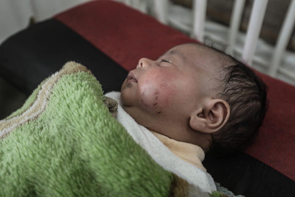 Newborn Adam al-Ustaz receives treatment at al-Rantisi Children's Hospital in Gaza City after being bitten by a rat inside a displacement tent, March 28, 2026. (Photo: Moiz Salhi/APA Images)
