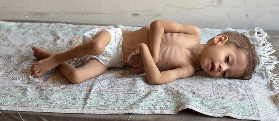 Hashem Abu Mustafa, 2, diagnosed with severe actue malnutrition at Nasser Medical Complex in Khan Younis, August 23, 2026. (Photo Muhammad Eslayeh)