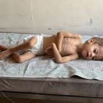 Hashem Abu Mustafa, 2, diagnosed with severe actue malnutrition at Nasser Medical Complex in Khan Younis, August 23, 2026. (Photo Muhammad Eslayeh)