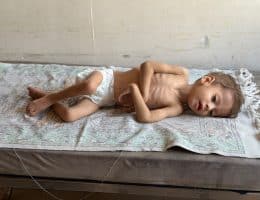 Hashem Abu Mustafa, 2, diagnosed with severe actue malnutrition at Nasser Medical Complex in Khan Younis, August 23, 2026. (Photo Muhammad Eslayeh)
