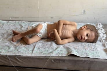 Hashem Abu Mustafa, 2, diagnosed with severe actue malnutrition at Nasser Medical Complex in Khan Younis, August 23, 2026. (Photo Muhammad Eslayeh)
