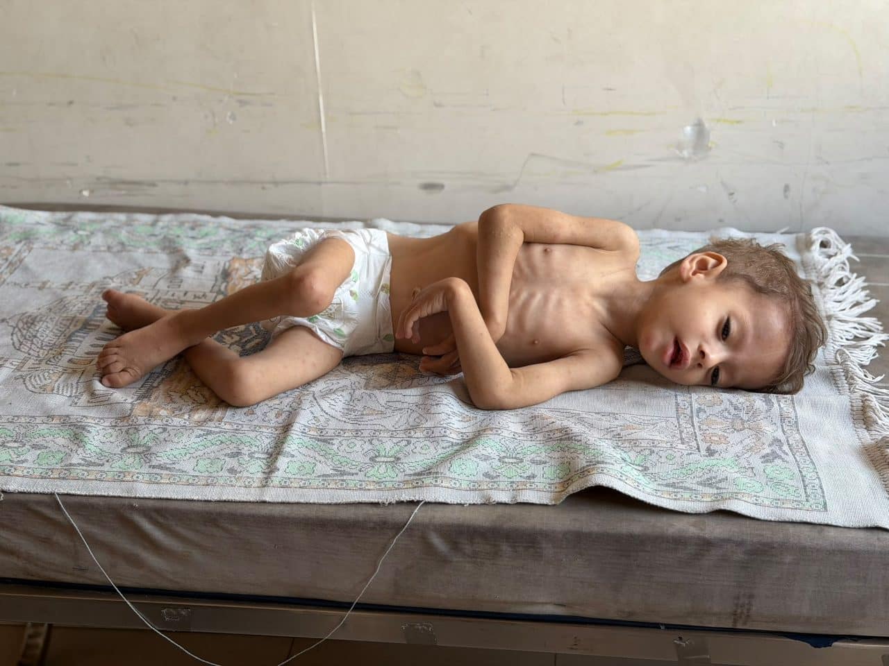 Gaza isn’t able to recover from famine as acute malnutrition soars across the Strip, new report finds